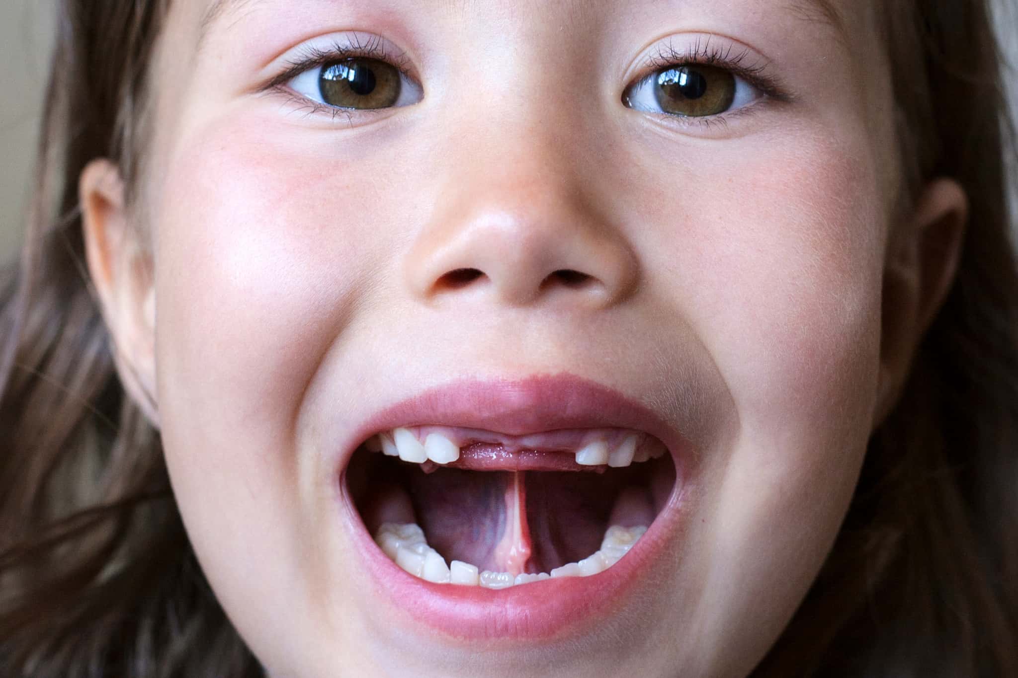 MFT（口腔筋機能療法）とは？行うメリットと流れ、注意点も