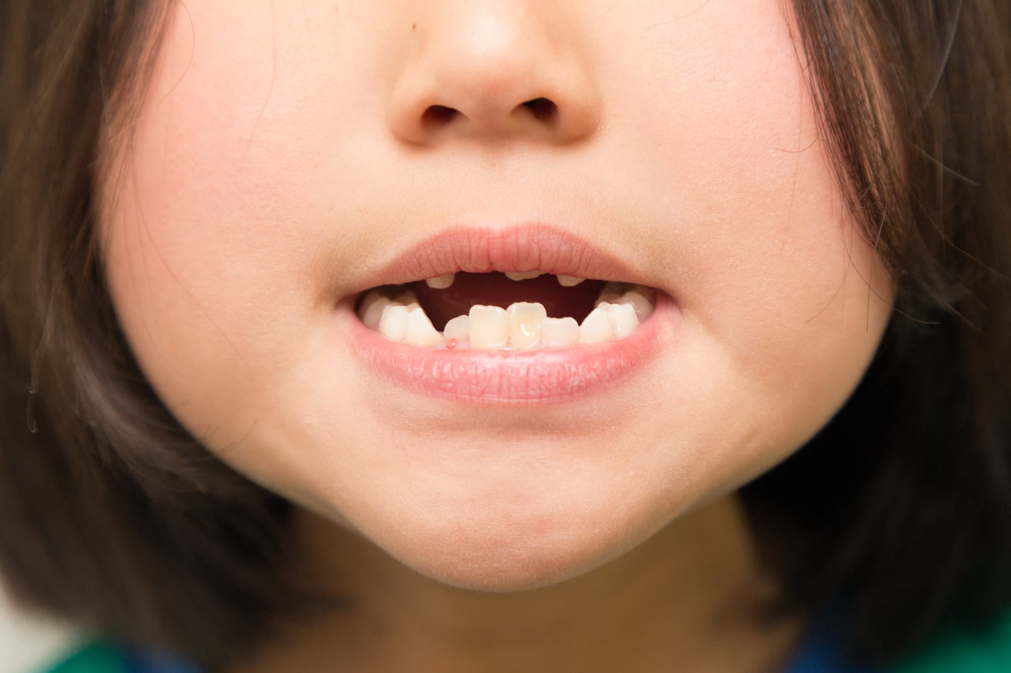 叢生で下顎前突の子どもの口元