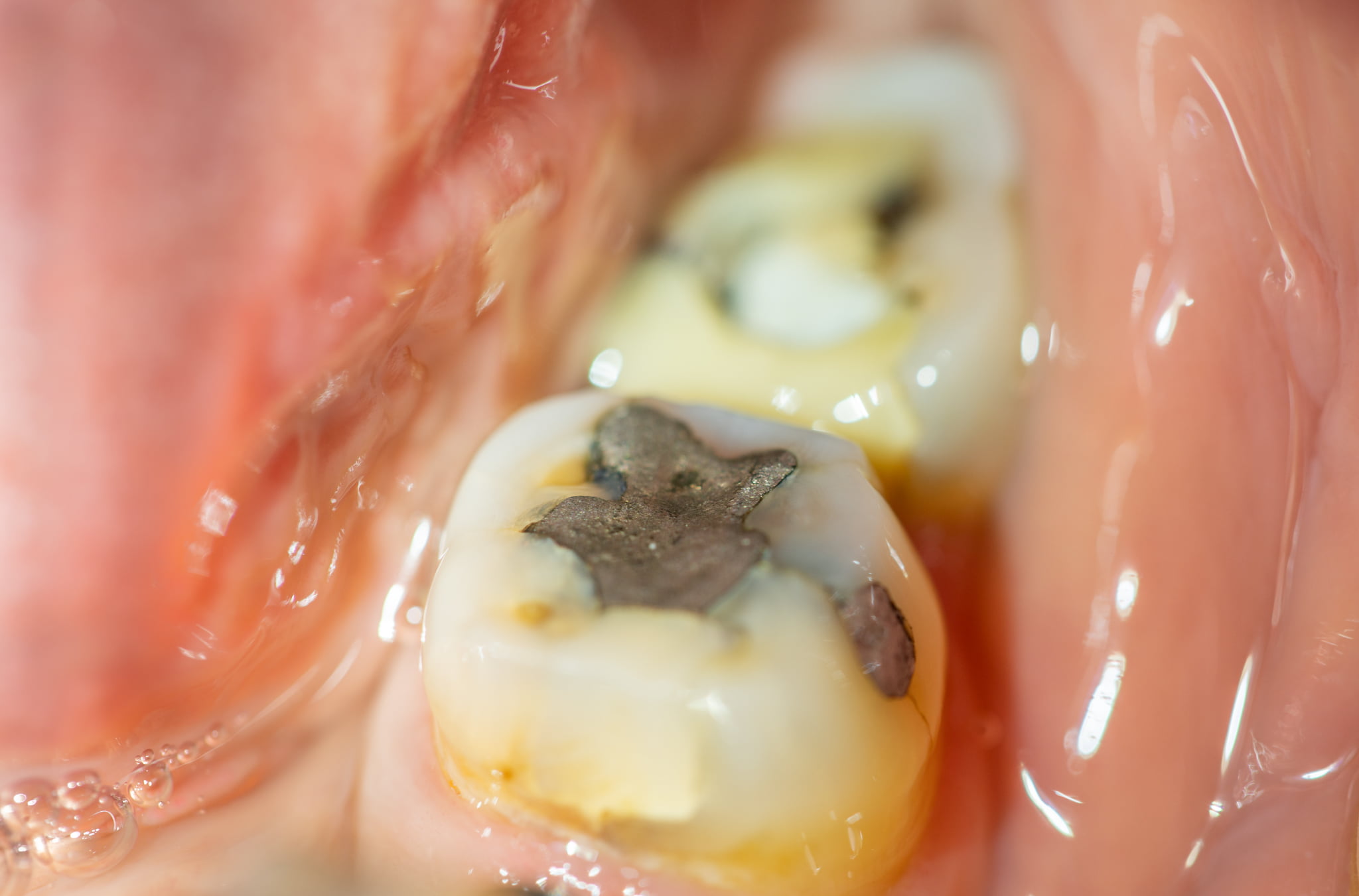 歯磨きが不十分な銀歯