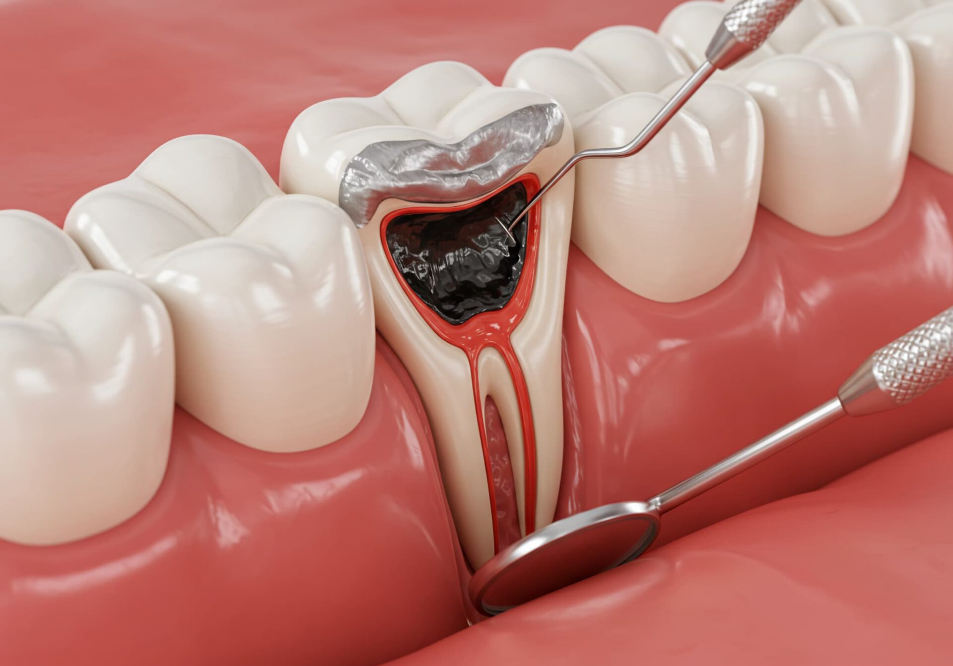 銀歯の下に潜む虫歯！原因と予防法を解説