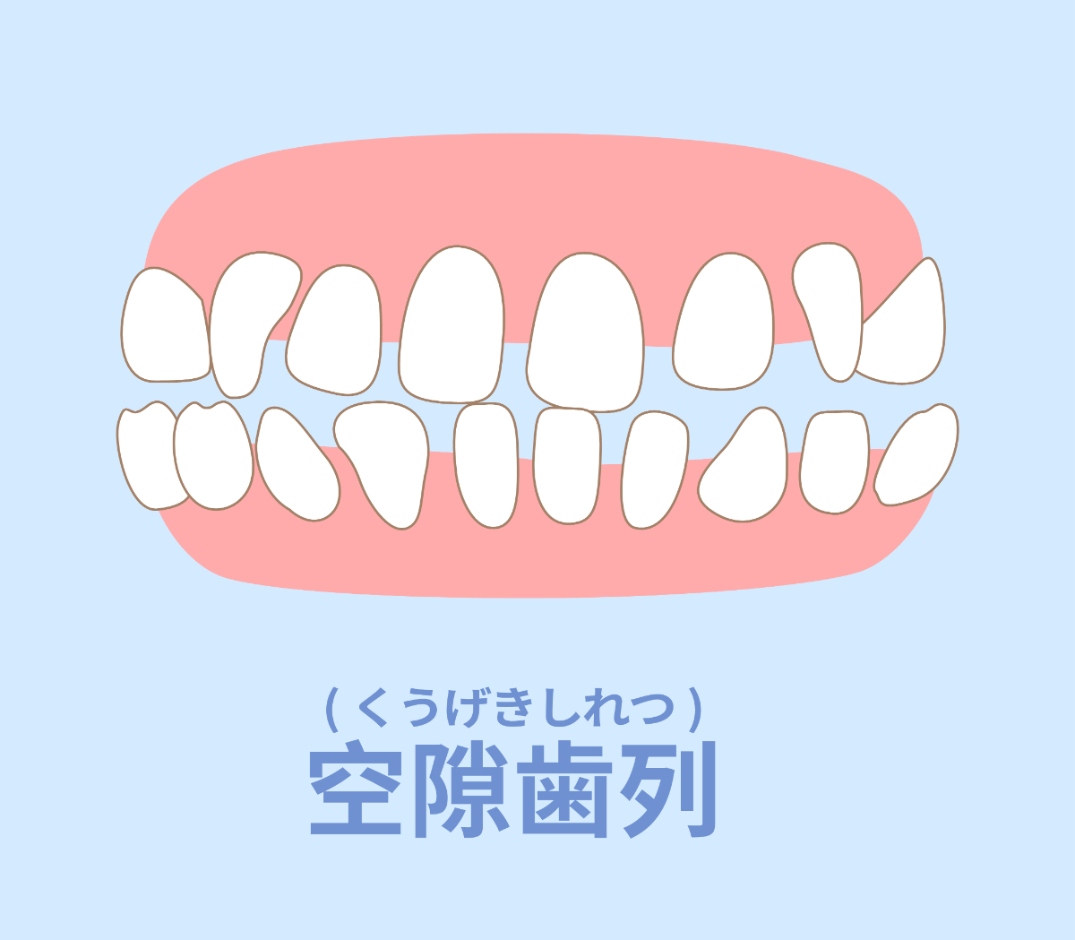 空隙歯列（くうげきしれつ）の様子