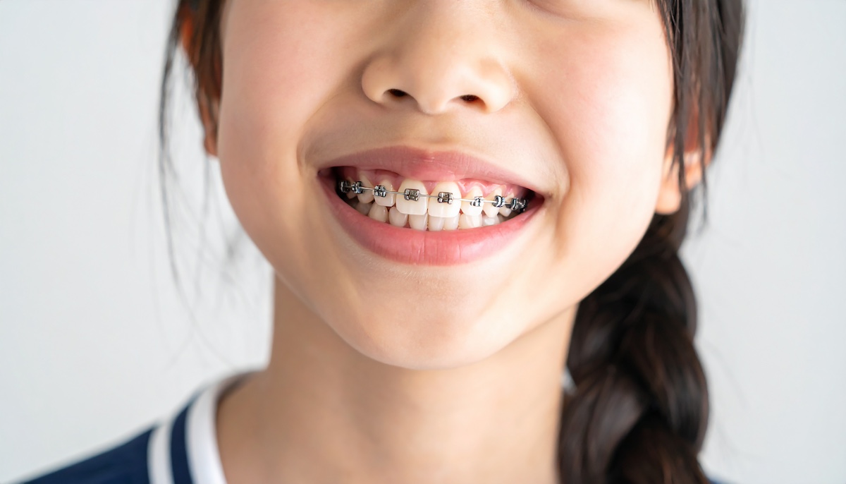 子どもがすきっ歯の矯正治療をしている